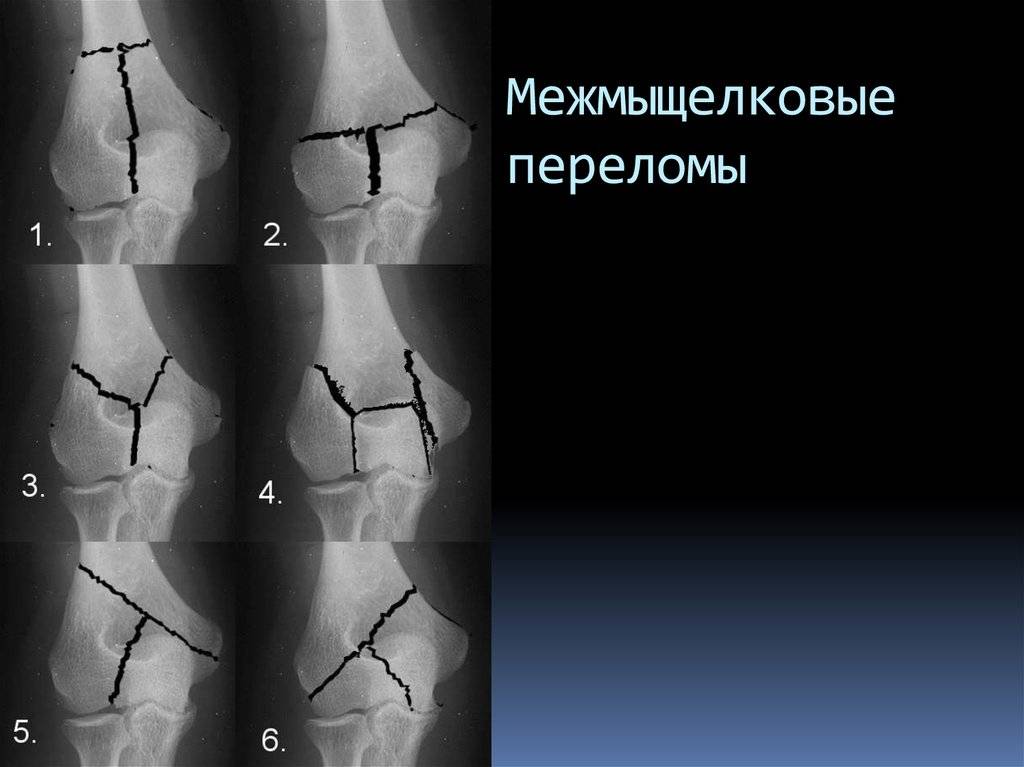 Перелом плеча | eurolab | травматология