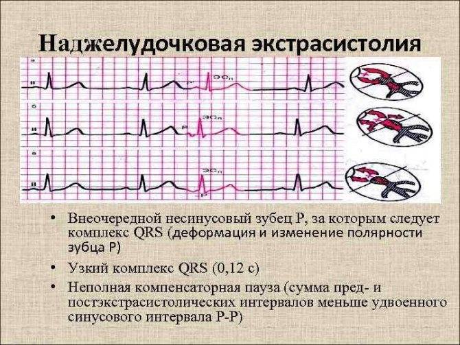 Внезапная сердечная смерть (всс): что это, причины и профилактика - сибирский медицинский портал