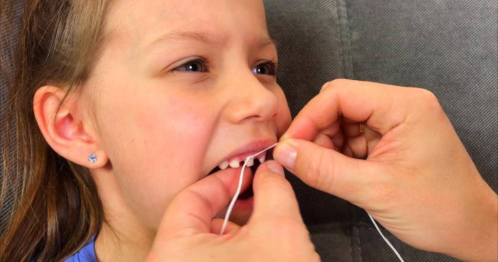 Удаление молочного зуба у детей - как удаляют и не опасно ли это