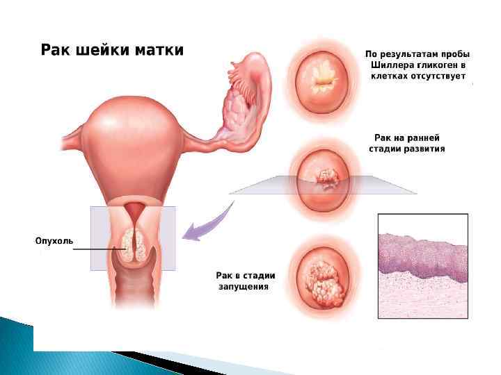 Признаки рака шейки матки. симптомы рака шейки матки