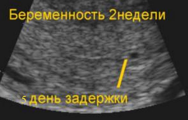 Эрозия шейки матки при беременности | компетентно о здоровье на ilive