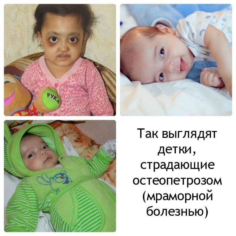 Мраморная болезнь у детей: симптомы остеопетроза с фото
