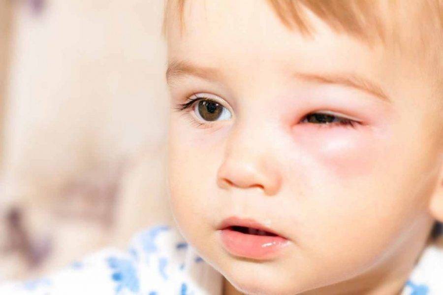 Что делать, если отек глаз у ребенка после сна?