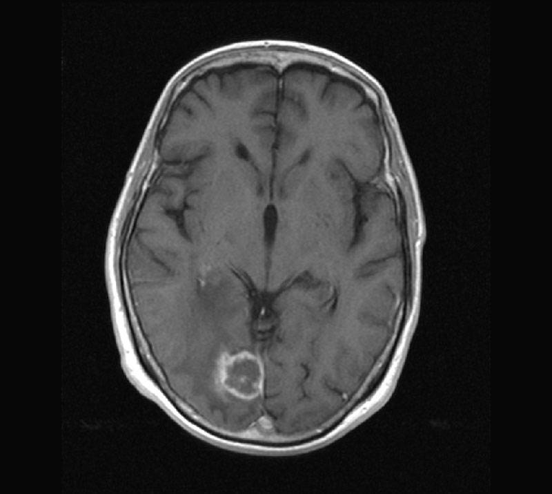 Расшифровка мрт головного мозга  как выглядит мрт снимок головы в норме