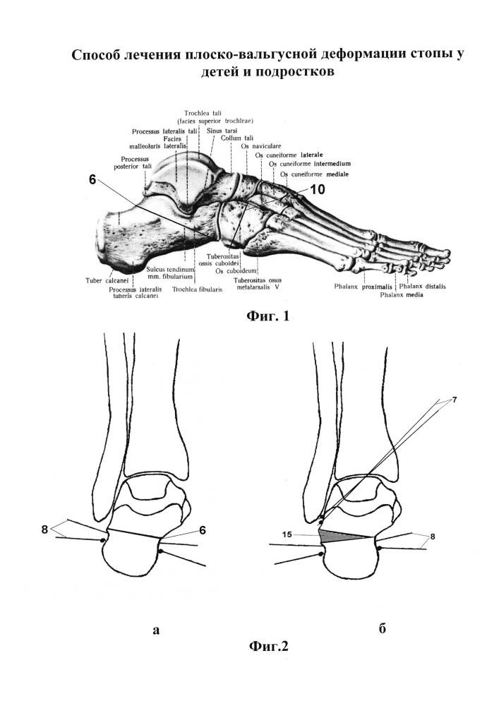 Хирургическая коррекция вальгусной деформации коленного сустава у взрослых введение | фото до и после, операция, отзывы, лечение, реабилитация и восстановление