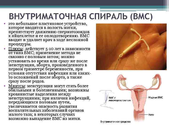 Мирена (гормональная спираль) - установка, удаление, цена в москве