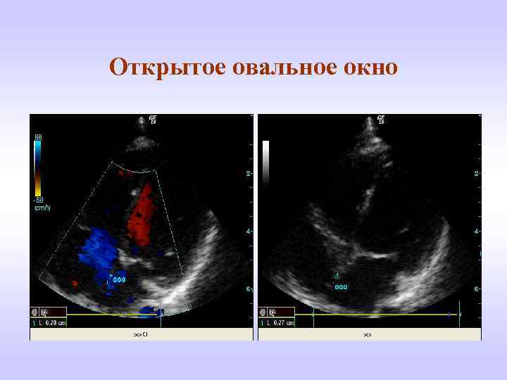 Открытое овальное окно в сердце - диагноз у ребенка, у новорожденного, у взрослых - docdoc.ru