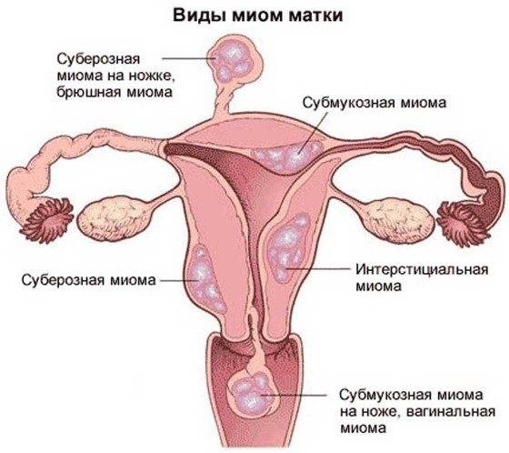 Беременности при гиперплазии эндометрия: возможность зачатия и вынашивания, отзывы