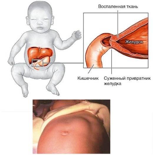 Стеноз привратника желудка (пилоростеноз) у детей