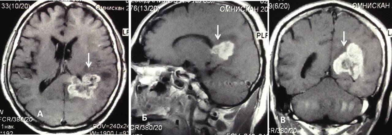 Рак мозга у детей | симптомы и лечение рака мозга у детей | компетентно о здоровье на ilive