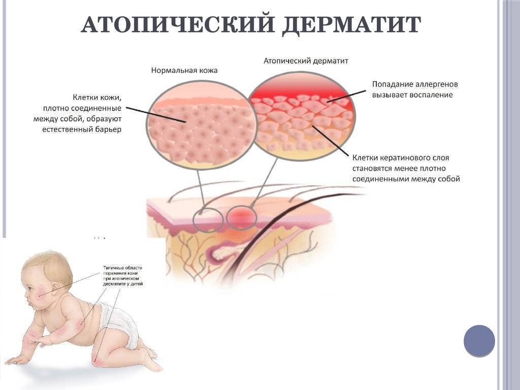 Атопический дерматит. информация для пациентов - доказательная медицина для всех