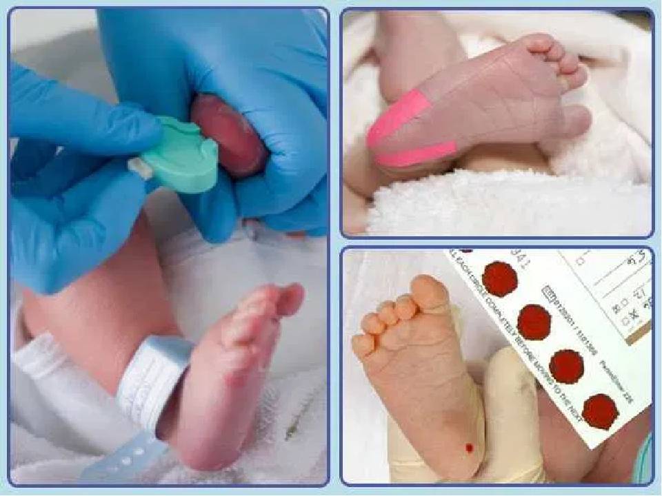 Неонатальный скрининг новорожденных в роддоме на наследственные заболевания (анализ крови из пятки)