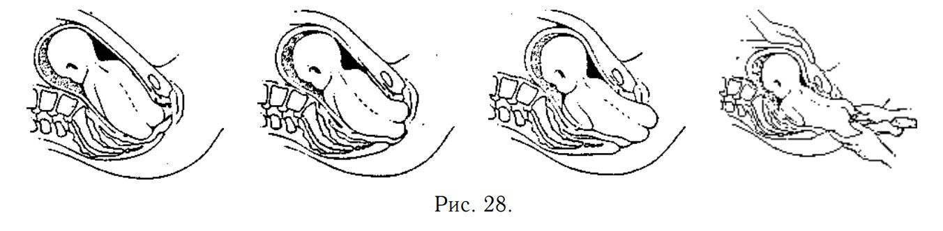 Упражнения для беременных перед родами, чтобы ребенок перевернулся вниз головой при тазовом предлежании
