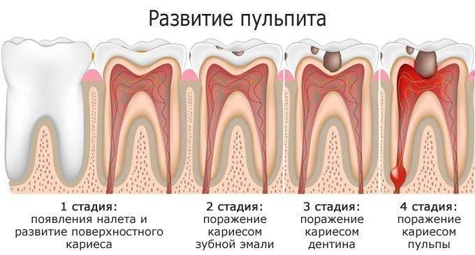 Лечение пульпита постоянных детских зубов | динозубрик - детская стоматология в нижнем новгороде