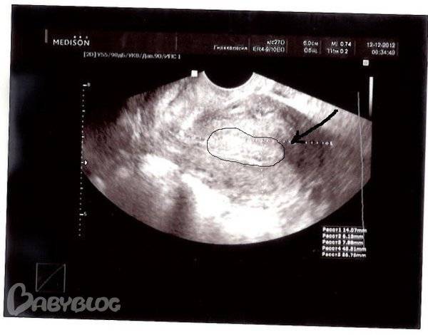 Можно забеременеть с полипом в матке. УЗИ полипа эндометрия при беременности. Маточная беременность на УЗИ на раннем сроке.