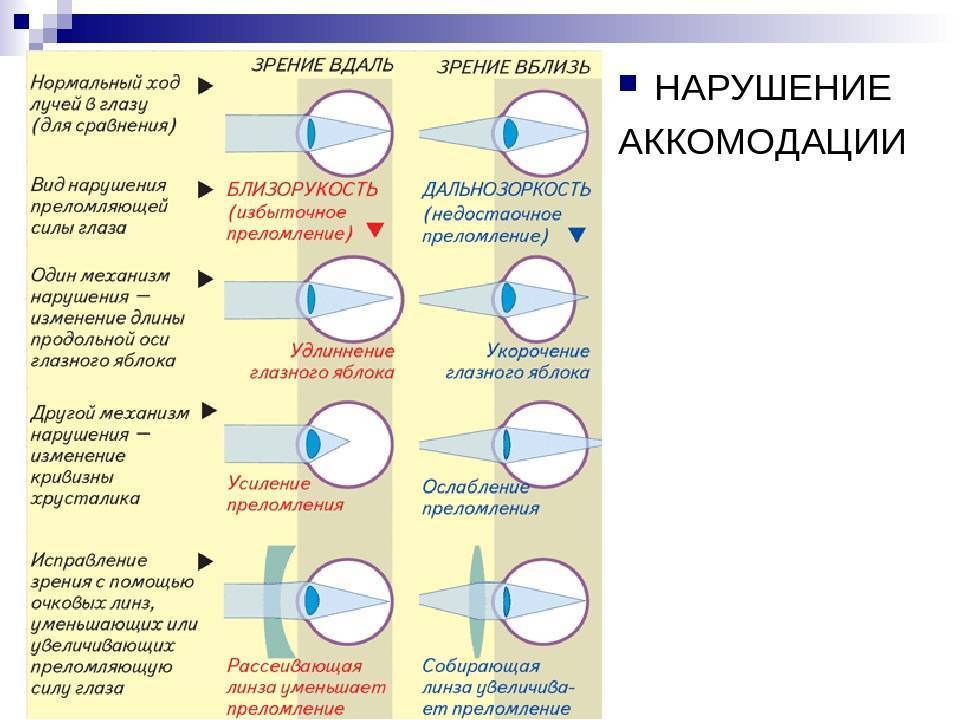Спазм аккомодации глаз: что это, как снять, лечение, симптомы, капли «ochkov.net»
