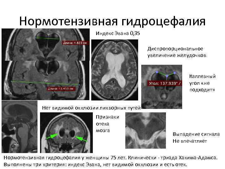Гидроцефалия – лечение ведущими врачами москвы • русский доктор