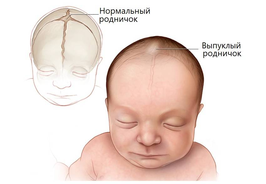 Маленький родничок у новорожденного ребенка: что значит маленькое темечко, что говорит комаровский о последствиях