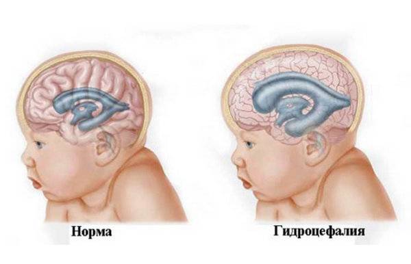 Лечение энцефалопатии головного мозга у взрослых — брейн клиник