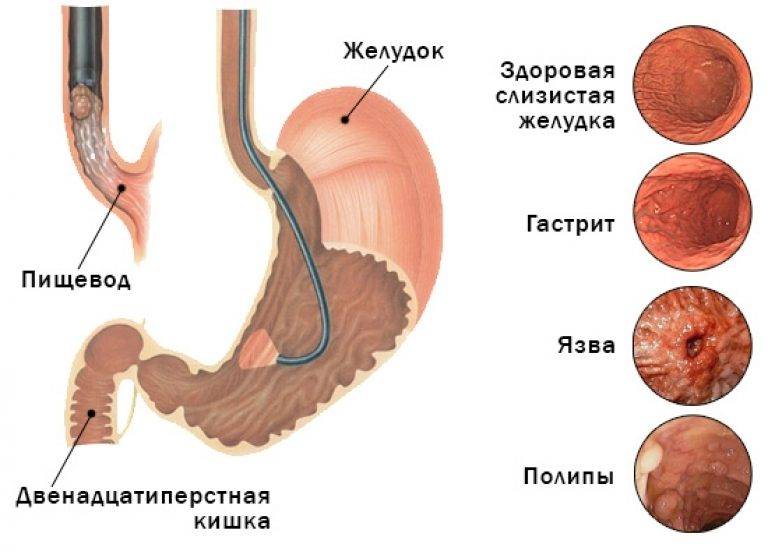 Гастроскопия желудка и колоноскопия сделать в москве (фгдс, эгдс) | медицинский центр «президент-мед»