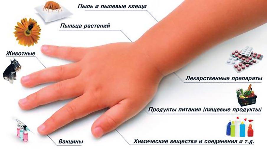 Аллергия на стиральный порошок на коже: причины, симптомы и лечение