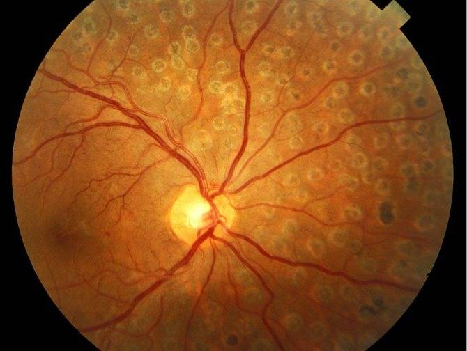 Ангиопатия сетчатки глаза у ребенка - что это такое и как лечится?