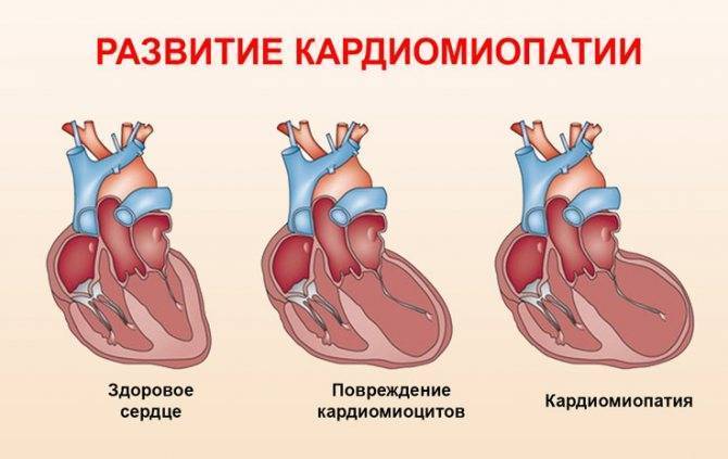 Диагностика дилатационной кардиомиопатии у детей | компетентно о здоровье на ilive
