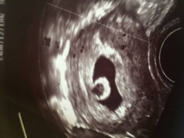 Эмбрион не визуализируется: что это значит, почему на 5–6 неделе беременности не видно зародыша?