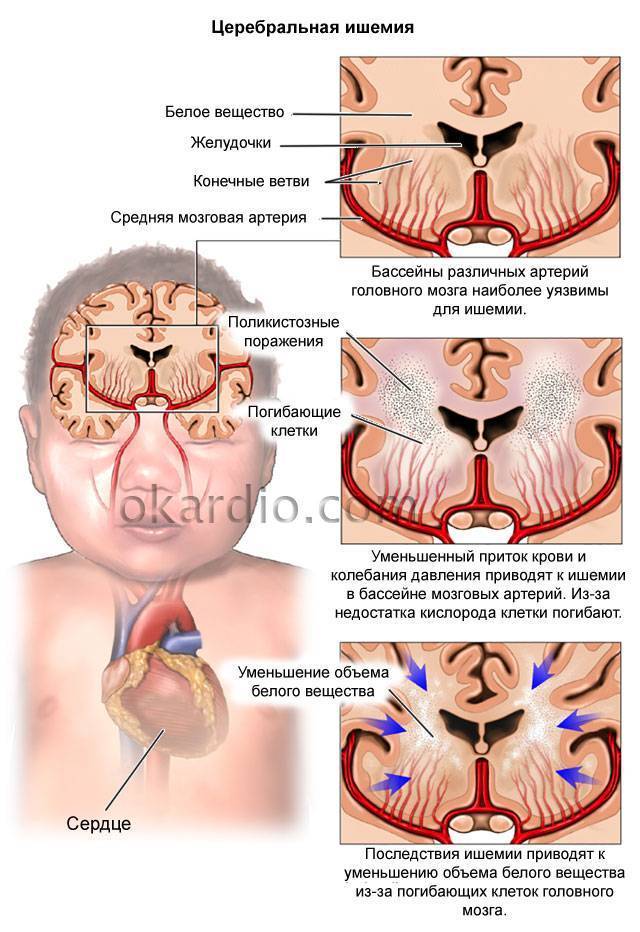 Гипоксия плода. причины и последствия гипоксии у новорожденных