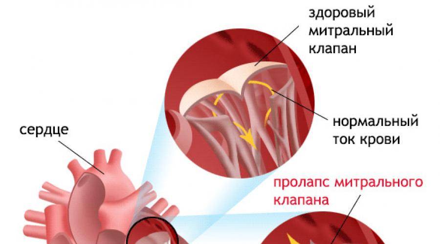 Пороки сердца врожденные и приобретенные: диагностика и лечение