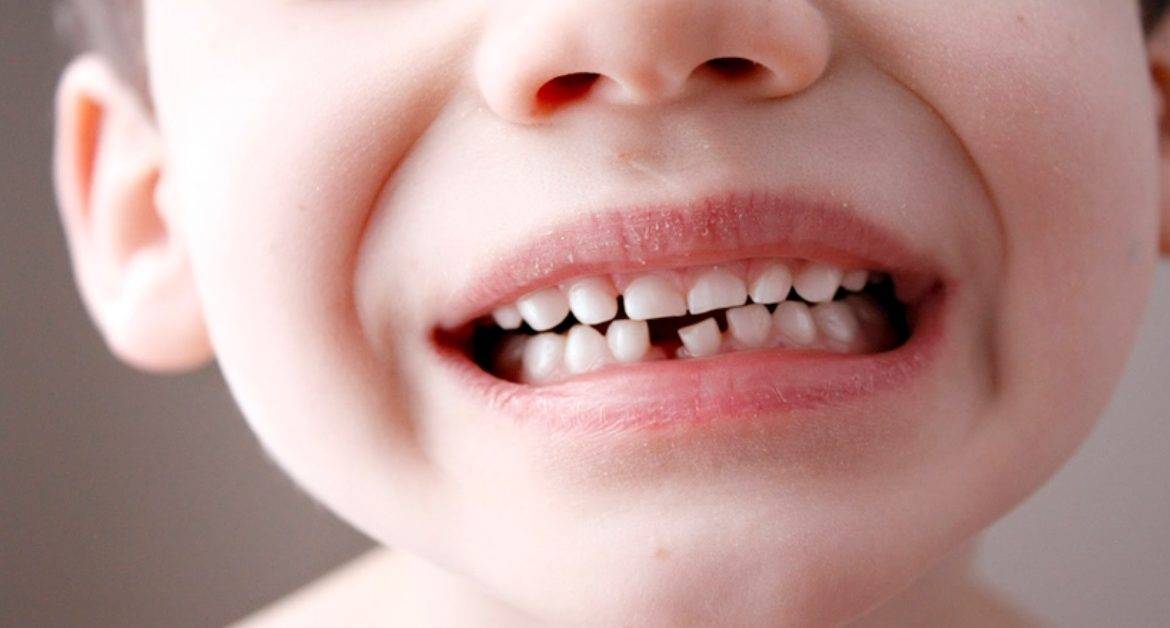 Когда выпадают молочные зубы у детей - первые признаки выпадения