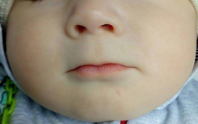 Увеличенные миндалины у ребенка - о чем свидетельствуют?