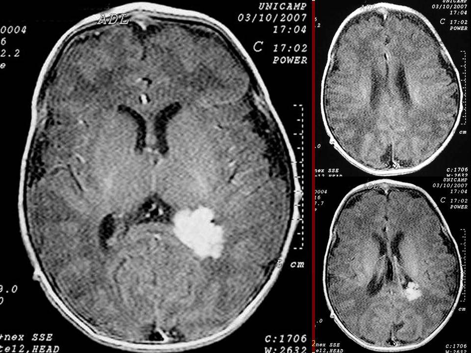 Эпидуральные гематомы головного мозга — симптомы и способы лечения гематом головного мозга в клинике целт