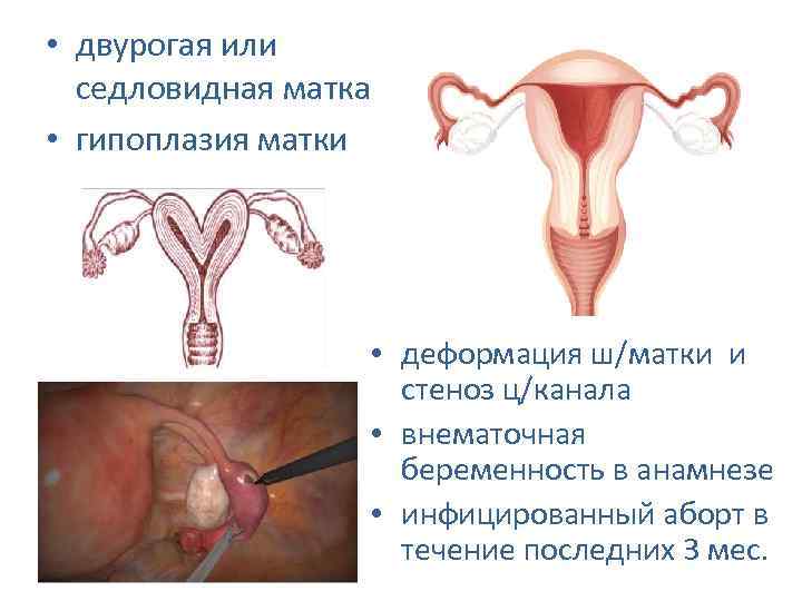 Детская матка: причины и лечение – можно ли забеременеть и родить с детской маткой — медицинский женский центр в москве