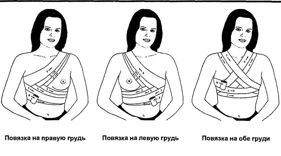 Как перетянуть грудное молоко (перевязать грудь) для предотвращения лактации: фото