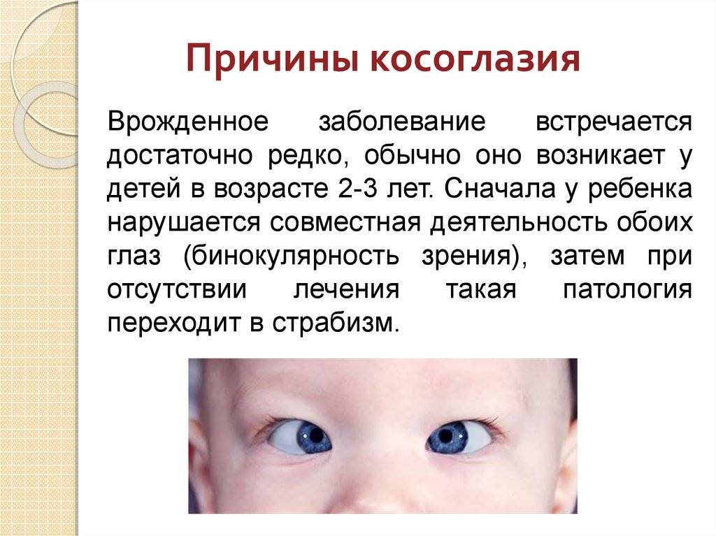 У новорожденного косят глазки: причины, когда проходит