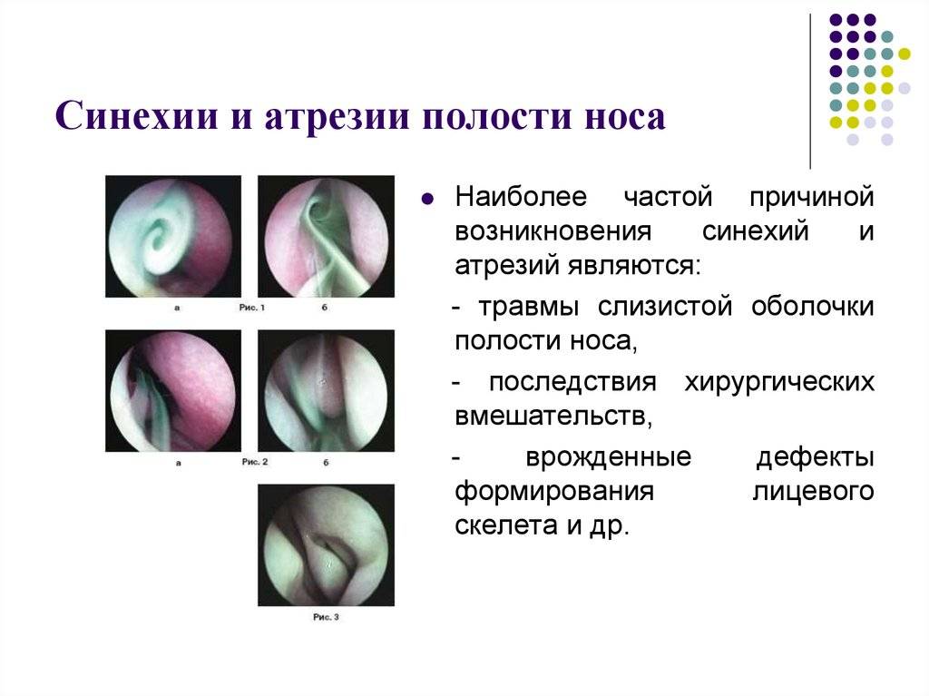 Лечение атрофического вагинита