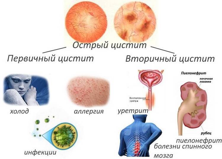 Цистит у мужчин | симптомы | диагностика | лечение - docdoc.ru