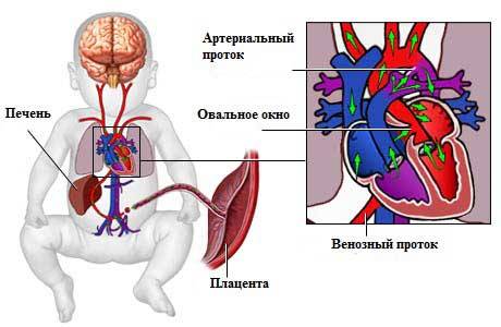 Аортальный стеноз | эндоваскулярное лечение врожденных пороков сердца в институте амосова