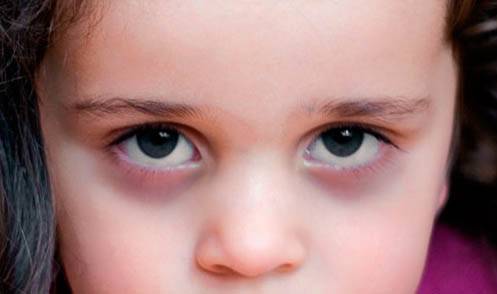 Хронические синяки и темные круги под глазами: как бороться?