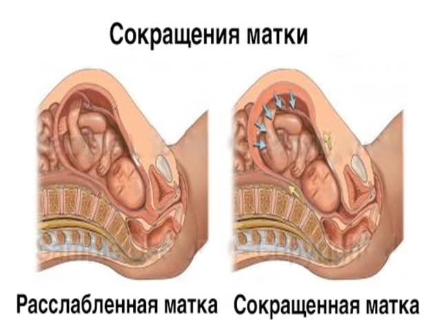 Утрожестан при планировании беременности