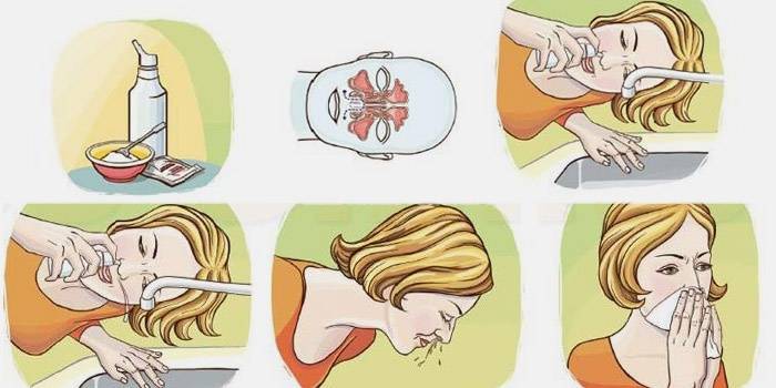 Как промыть нос ребенку правильно в домашних условиях: средства при насморке и заложенности