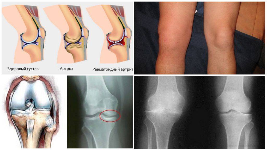 Односторонний разрыв. Ювенильный артрит коленного сустава рентген. Остеоартроз скакательного сустава. Артропатия коленных суставов. Полиартрит коленного сустава.