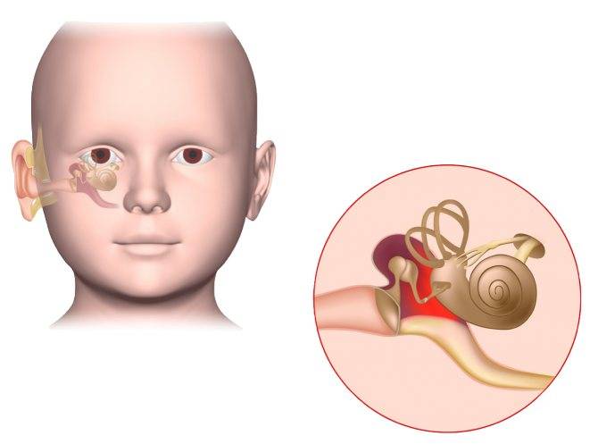 Снижение слуха у ребенка - причины и лечение