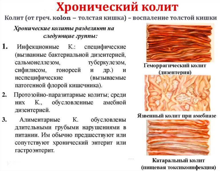 Кал при раке кишечника: цвет кала при онкологии, форма кала при раке кишечника, фото кала при раке кишечника
