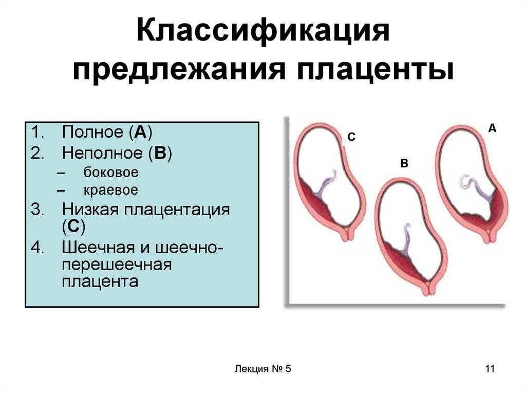 Переднее предлежание плаценты