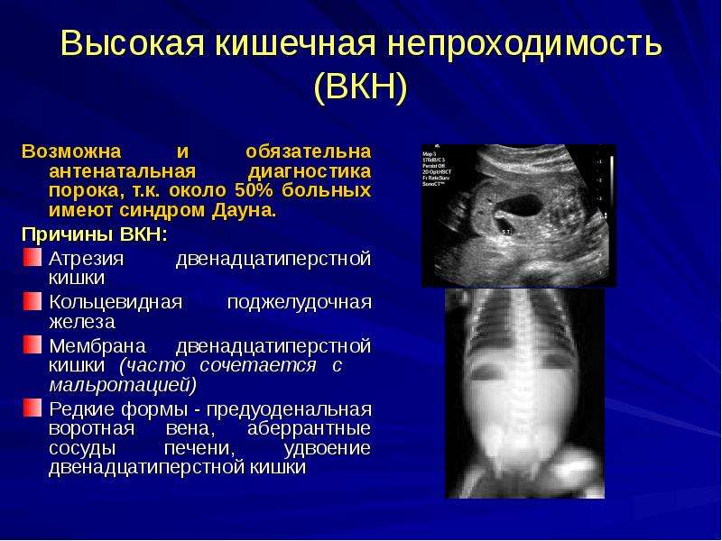 Непроходимость кишечника. причины, симптомы, диагностика и лечение кишечной непроходимости.!