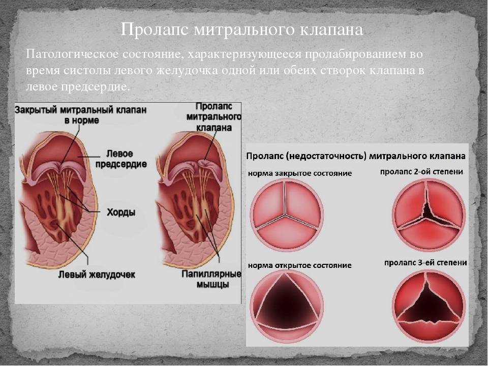 Пролапс митрального клапана