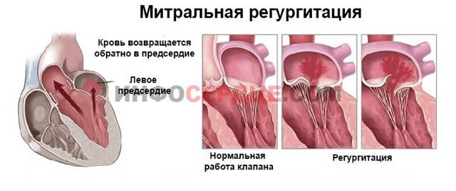 Диагностика и классификация пролапса митрального клапана у детей и подростков