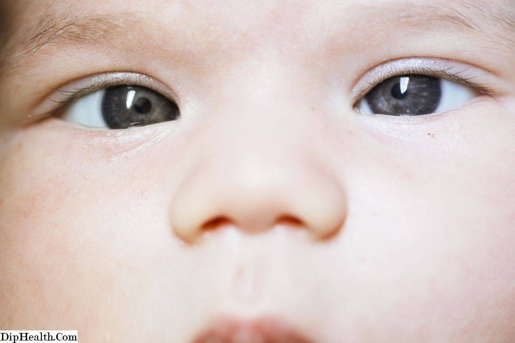 Косоглазие у новорожденных (грудничка): когда проходит, почему косят глаза у детей до года